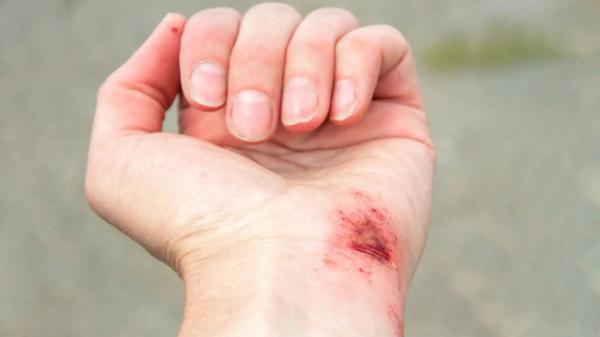 6 باور غلط درباره مراقبت از زخم